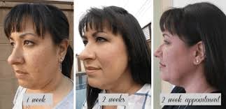 Your provider selects several injection sites where kybella is administered. Kybella Results My Transformation Cosmeticare