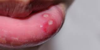 Image result for syphilis ulcer