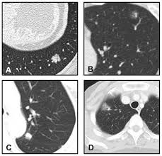 But many other cancers can metastasize to bone, including: Diagnosis And Surgical Resection Of Solitary Pulmonary Nodules In Patients With Breast Cancer