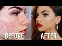 How To Cover ACNE & SCARS with Makeup! Full Coverage Foundation & Concealer Tutorial | Kayleigh P. Video | Beautylish