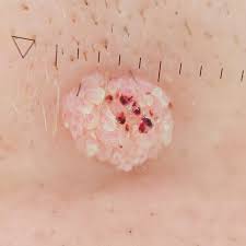 Image result for verrucae filiformes