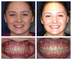 The treatment procedure to fix a crooked smile without surgery in the dental industry is known as cosmetic dentistry. Orthodontic Smile Gallery Cosmetic Dentistry Photos Images