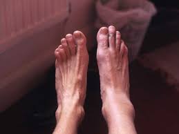 An allergic reaction to the spider venom can occur. Signs Of A Spider Bite