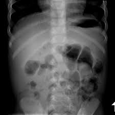 Image result for Spinal Dysraphism