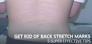 Get Rid Of Stretch Marks On Your Back 5 Super Effective Tips Helloderma Com Stretch Marks Rid Skin Concern