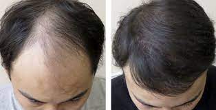 This hairstyle trend has been going strong for years and even up to this day, so feel free to rock it! Orange County Asian Hair Transplants Modena