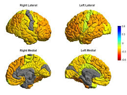 Just like most mental illnesses. New Mri Study Leads To Roadmap Of Bipolar Brains Psychology Today