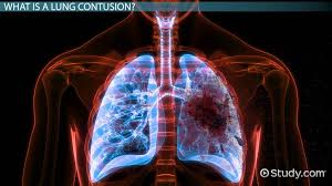 Image result for Pulmonary Contusion