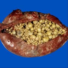 Check spelling or type a new query. Gallstones And Sludge Radiology Key