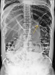 Image result for Sigmoid Volvulus