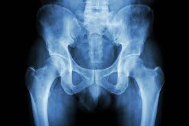 Image result for Hip XRay