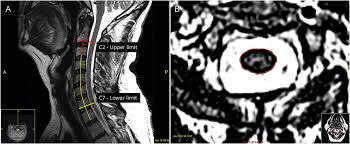 Cervical Spinal Cord Atrophy Neurology Neuroimmunology Neuroinflammation
