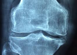 Entstehung knorpelschaden, arthrose therapie verstehen. Comment Diminuer La Douleur Et Maintenir Une Bonne Qualite De Vie Avec Un Diagnostic D Arthrose Kinatex Saint Roch