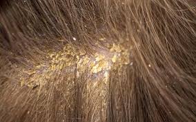 Image result for sores on the head in children