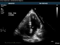 Image result for Cardiac Contusion