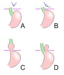 Hiatus Hernia
