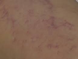 The name often refers to just the cancerous versions rather than all such tumours. Cutaneous B Cell Lymphoma Dermnet Nz