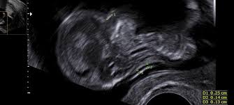 Bis jetzt konnte nie ein schädlicher einfluss auf das kind oder die mutter gezeigt werden. Ersttrimesterscreening Nackenfaltenmessung Chromosomenstorung