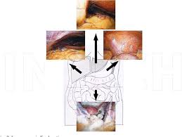 Additionally, omental mesothelioma is a rare type of mesothelioma that forms in the omentum, a part of the peritoneum that connects the stomach with other abdominal organs. Pdf Laparoscopy And Well Differentiated Papillary Mesothelioma Of The Peritoneum Semantic Scholar