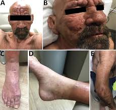Image result for Leprosy