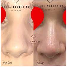 This procedure allows us to shorten, lengthen, and modify the nasal shape. The Non Surgical Nose Job Facial Sculpting