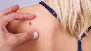 Merkel cell carcinoma is a rare type of skin cancer that usually starts in areas of skin exposed to the sun. Merkel Cell Carcinoma Skin Cancer Rates Rising In U S Allure