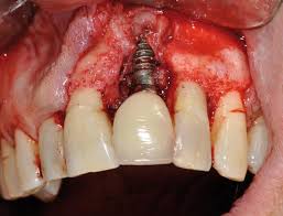 3 Symptoms Of Tooth Infection Spreading To Bloodstream Video