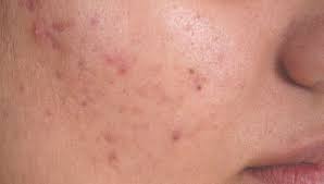 I came, i saw, i did the research for you. Boil Vs Pimple Tips For Identification