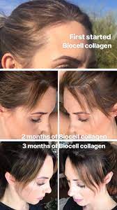 Others have shown that consuming collagen can increase density in bones weakened with age and can improve joint, back. Collagen For Hair Growth Collagen For Hair Growth Collagen For Hair Collagen Benefits