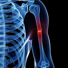 There are two types of stress fractures. Symptoms Of A Broken Bone Urgentmed Network