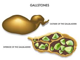 Gallstones do not pass, but instead get stuck in the gallbladder, or ducts. Water Can Heal Water And Gallstones Apec Water