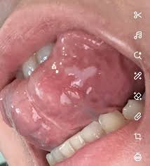 Image result for white cancer on tongue)