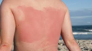 Kostenlose lieferung für viele artikel! Sonnenbrand Was Tun Behandlung Hausmittel Dauer Und Verlauf Onmeda De