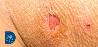 Image result for Skin Ulcer