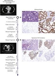 Cover all your repairs with one easy plan. Histologic Transformation Of Alk Rearranged Adenocarcinoma To Squamous Cell Carcinoma After Treatment With Alk Inhibitor Lung Cancer