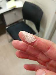 Mix unless you get a smooth paste. Hydrogen Peroxide Burn Mildlyinteresting