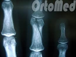 Kůže je zemitá, hrudník se podobá hlaveň a prsty se deformují. Falangie Prsty Jsou Pripojeny Z Toho Jsou Psyched Phalange A Mytne Klouby Studijni Anatomie