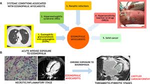 Contemporary reviews in cardiovascular medicine. Management Of Acute Myocarditis And Chronic Inflammatory Cardiomyopathy Circulation Heart Failure