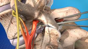 Slipped disc in lower back (hindi) video description: Microdiscectomy Mld Usc Spine Center