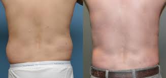 Liposuction for men for safe pain free wnwanted fat vaser removal