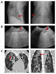 Symptoms of abscess due to aerobic bacteria develop more acutely and resemble bacterial pneumonia. Research Says In Sars Cov 2 Canine Infection Transmission Unlikely
