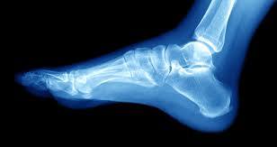 It's like hitting your funny bone. Lateral Malleolus Fracture Symptoms And Treatment