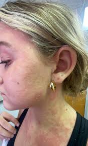 What can soothe itchy scalp eczema daily?