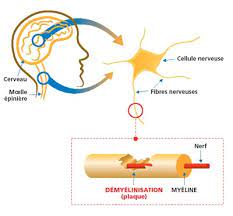 Vaccin et sclã©rose en plaques condamnation sanofi. Vaccin Contre L Hepatite B Et Sclerose En Plaques La Sclerose En Plaques Sep