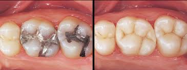 Flowery Tooth Extraction Healing Home Remedies Oralhealtheducation Toothextractioncondensedmilk Dental Dental Hygenist