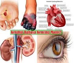 Jangan dulu berputus asa, karena penyakit ini masih bisa diatasi dan dikendalikan. Bagimana Munculnya Gejala Kencing Manis Dan Pencegahannya Berikut Tipsnya