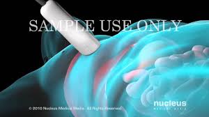 (1) a surgical procedure in which a small piece of tissue is removed from a patient. Liver Biopsy Youtube