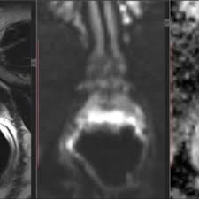 Irm ColoanÄƒ LombarÄƒ SecÈ›iune SagitalÄƒ T2 È™i T1 Download Scientific Diagram