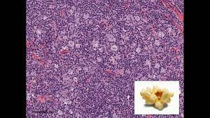 Histopathology Nodular Lymphocyte Predominant Hodgkin Lymphoma Youtube