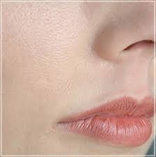 What Is The Best Laser Treatment For Acne Scars And Large Pores